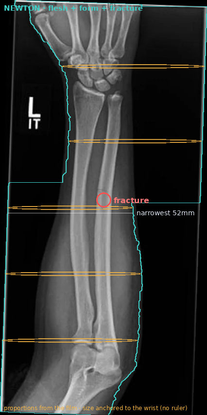 Egas's read: flesh silhouette traced, cross-section contour, and the fracture flagged on the real film