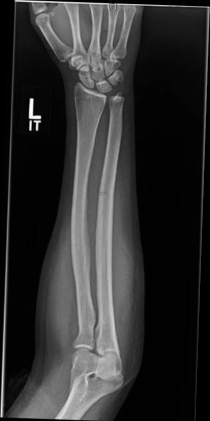 A real forearm X-ray: radius and ulna with a mid-shaft both-bone fracture, soft-tissue silhouette